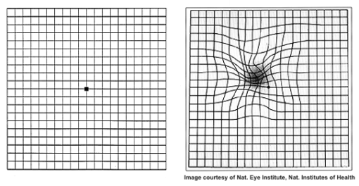 Amsler Grid in AMD - Cure AMD Foundation