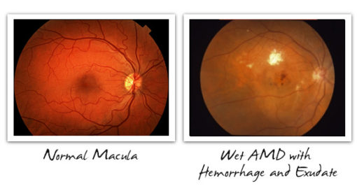 Dry & Wet AMD - Signs, Symptoms, and Diagnosis - Cure AMD Foundation