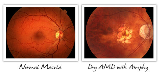 Dry & Wet AMD - Signs, Symptoms, and Diagnosis - Cure AMD Foundation