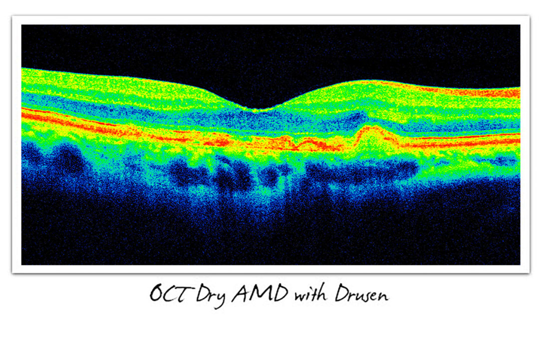 Dry & Wet AMD - Signs, Symptoms, and Diagnosis - Cure AMD Foundation