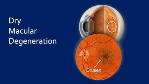 Dry-age-related-macular-degeneration - Cure Amd Foundation