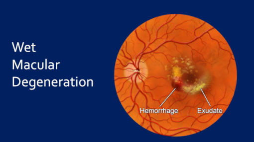 Wet-Age-Related-Macular-Degeneration - Cure AMD Foundation